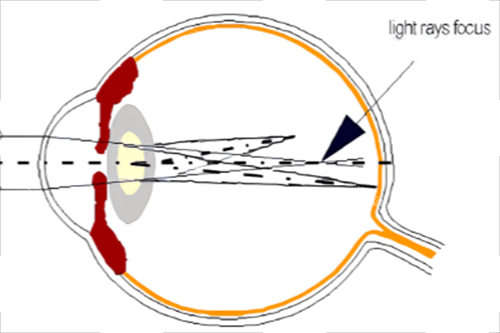 屈光不正散光示意图 屈光不正散光示意图