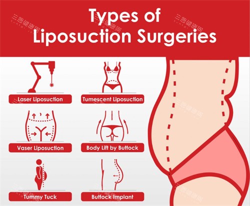 可以进行吸脂手术的部位 可以进行吸脂手术的部位