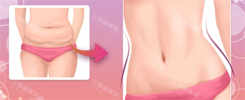 腹壁成形手术对比图 腹壁成形手术对比图