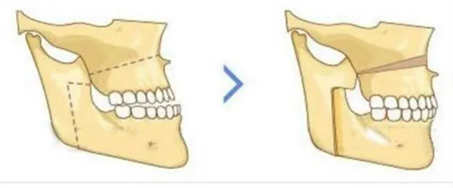 正颌手术操作示意图