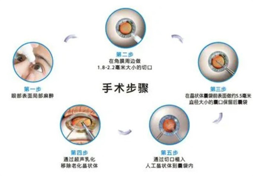 白内障手术过程图