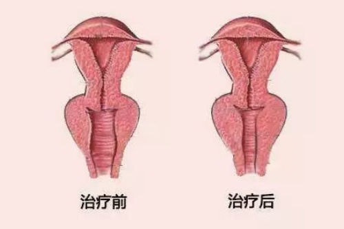 阴道紧缩卡通图