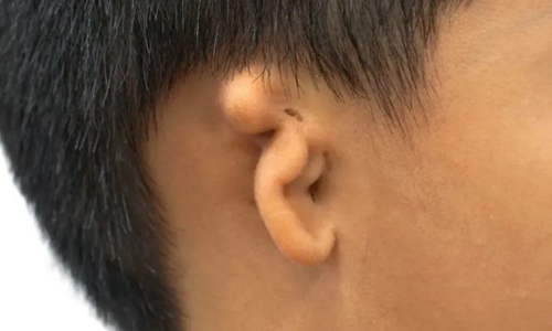 小耳畸形参考图