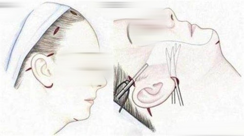 拉皮手术画线手术过程展示图