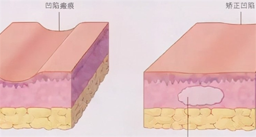 皮肤表面凹凸不平的动画展示