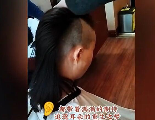 郭志华耳再造真人实例