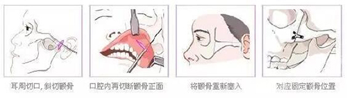 颧骨磨骨手术流程