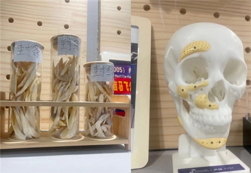 重庆松山整形磨骨手术展示图