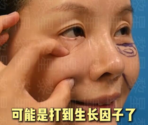 黎星生长因子取出术后评价