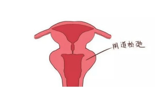 阴道紧缩样图