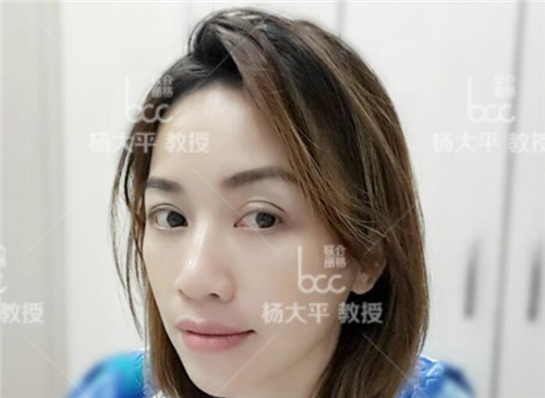 杨大平拉皮手术价格表