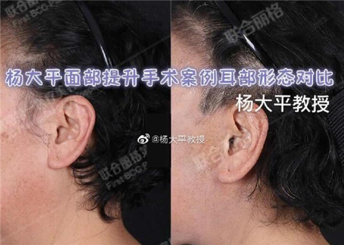 杨大平医生拉皮手术真人实例
