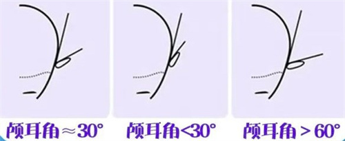 不同颅耳角的区别