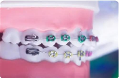 传统金属托槽矫正器