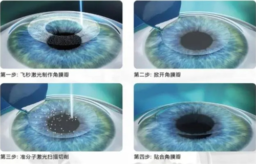 半飞秒手术图 半飞秒手术图