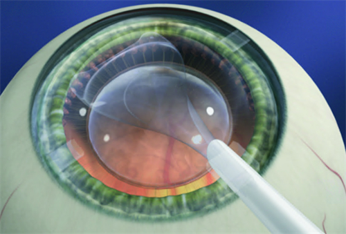 晶体植入手术图 晶体植入手术图