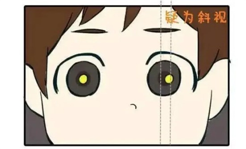 小朋友斜视素材图片 小朋友斜视素材图片