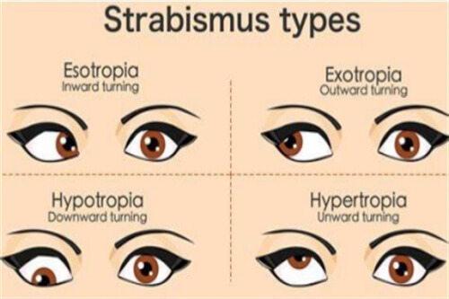 不同斜视对比图 不同斜视对比图