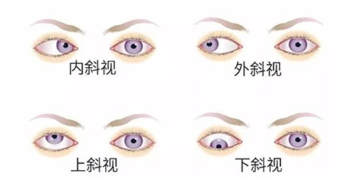 内外斜视、上下斜视 内外斜视、上下斜视