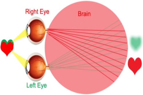 弱视示意图 弱视示意图