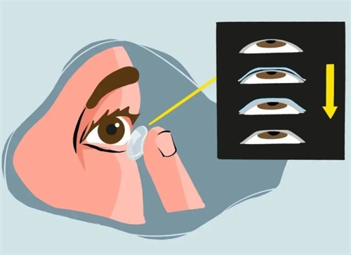 OK镜佩戴 OK镜佩戴