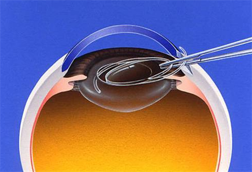 白内障晶体展示图 白内障晶体展示图