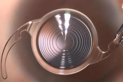 白内障晶体图片 白内障晶体图片