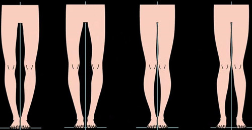 不同腿型卡通示意图