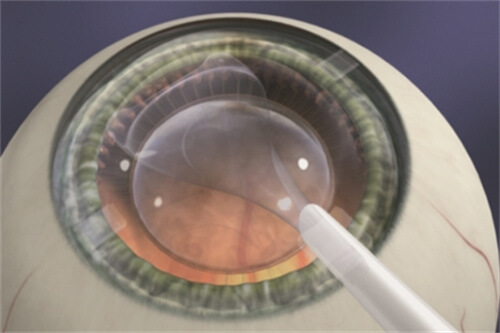 ICL晶体放入 ICL晶体放入