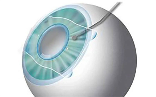 ICL晶体植入示意图 ICL晶体植入示意图