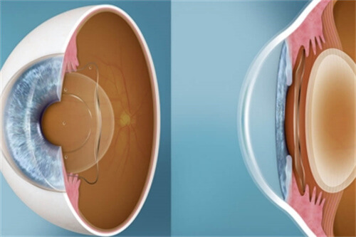 ICL晶体切面图 ICL晶体切面图