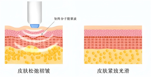 热玛吉作用对比