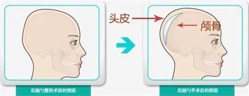 后脑勺手术