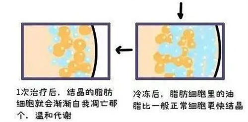 谁来说说冷冻溶脂到底有没有成效?听说做完冷冻溶脂很遭罪是真的吗?想去做又好纠结!