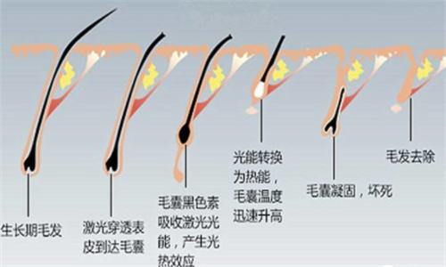 仪器脱毛前后对比
