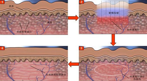 点阵激光作用于皮肤层次示意图