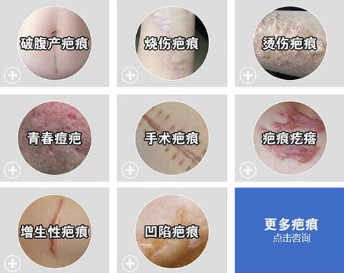 哪些疤痕需要祛除改善
