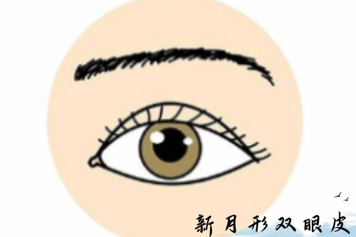 新月型双眼皮