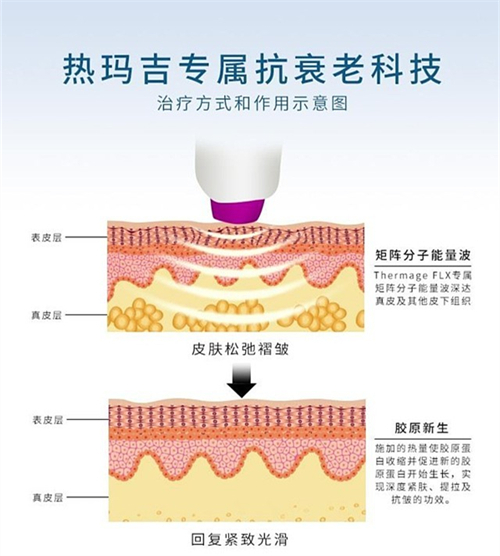 面部除皱热玛吉方式演示图