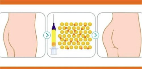 自体脂肪丰臀对比