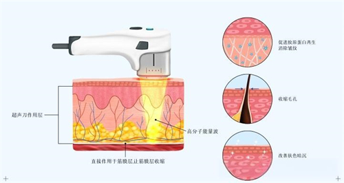 面部除皱热玛吉方式原理演示图