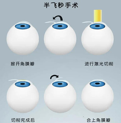 半飞秒手术卡通图