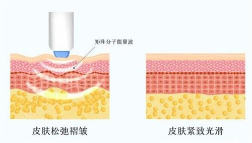 紧致肌肤**对比