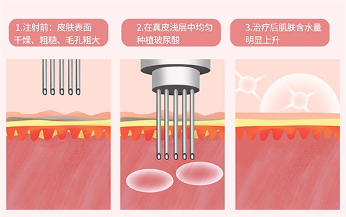 水光前后皮肤对比