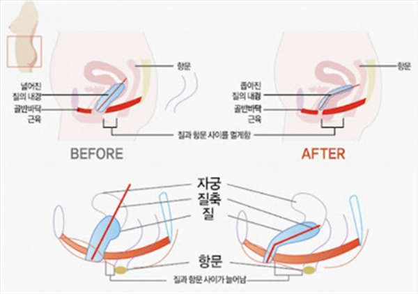 缩阴手术术前术后对比图