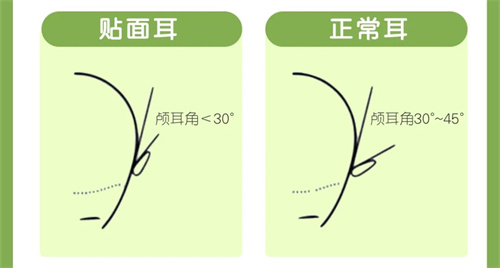 贴面耳与正常耳颅耳角对比图