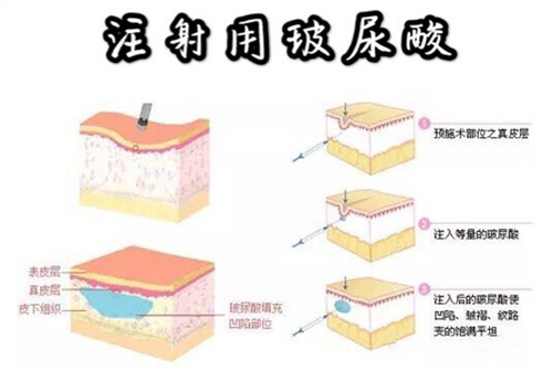 烟台鹏爱佳妍整形玻尿酸注射示意动画图