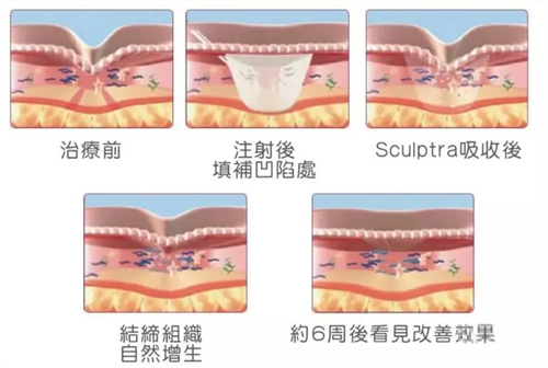 烟台鹏爱佳妍整形注射童颜针后皮肤的变化周期
