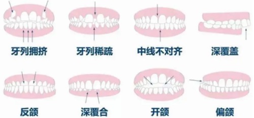 深圳玖艺口腔各种畸形牙齿示意图
