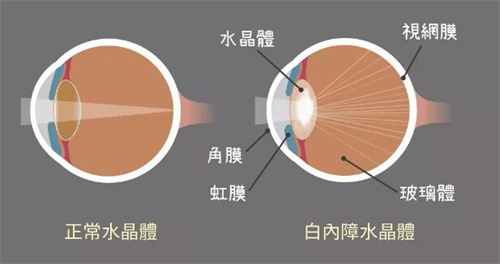 正常眼对比白内障区别